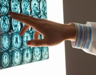 Researchers find protein associated with Alzheimer’s disease in brains of young people Researchers find protein associated with Alzheimer’s disease in brains of young