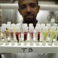 16 People Tested Positive for Tuberculosis Exposure at Northern California High 