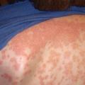 New Drug, Ixekizumab Proved Clinically Effective to Treat Psoriasis