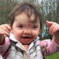 Girl Born with Frontonasal Dysplasia smiles Again with help of 3D Printing
